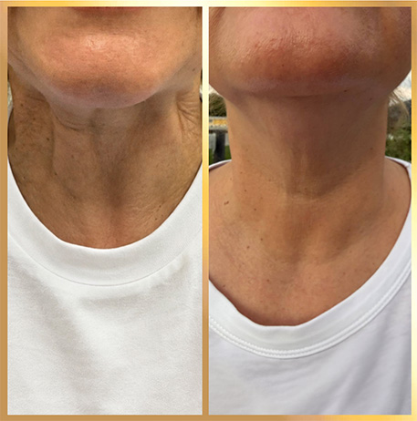patient Botox Nefertiti