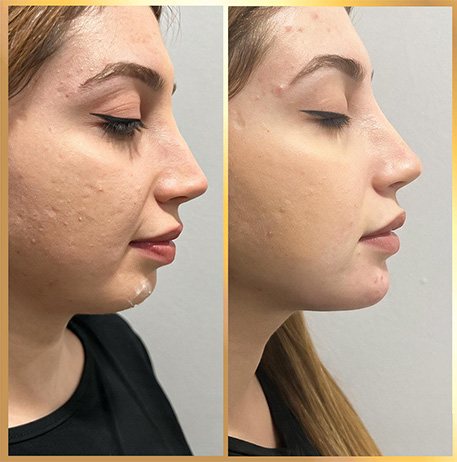 patient 1 Facial Harmonization