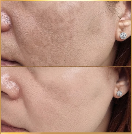 patient Melasma Treatment