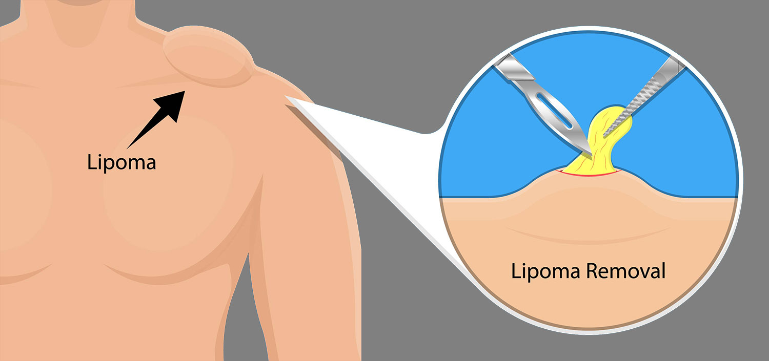 Lipoma Removal Miami | Avana Wellness Plus