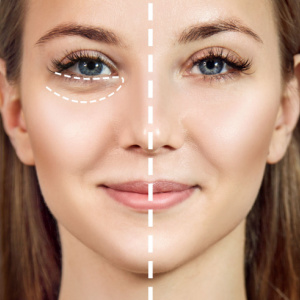 Under Eye Fillers Miami - Dark Circle Removal | Avana Wellness Plus