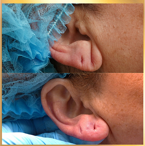 patient 5 Earlobe Repair