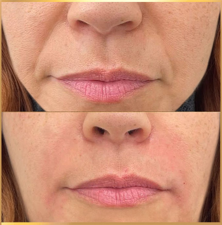 patient Nasolabial fold filler