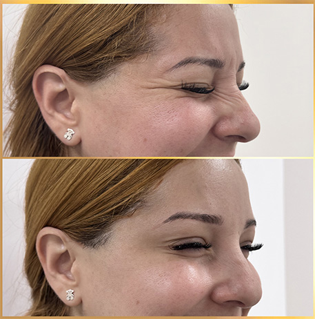 patient botox side