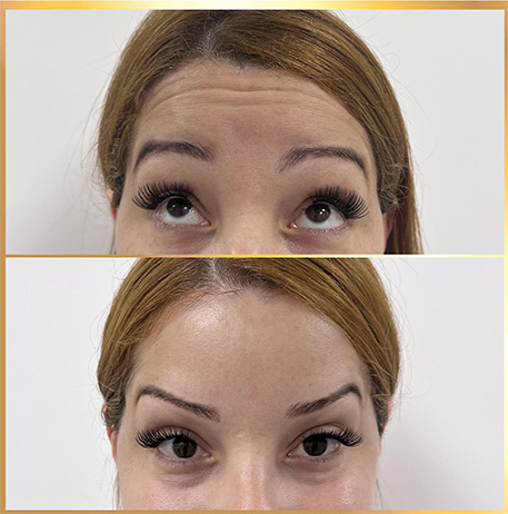 patient botox