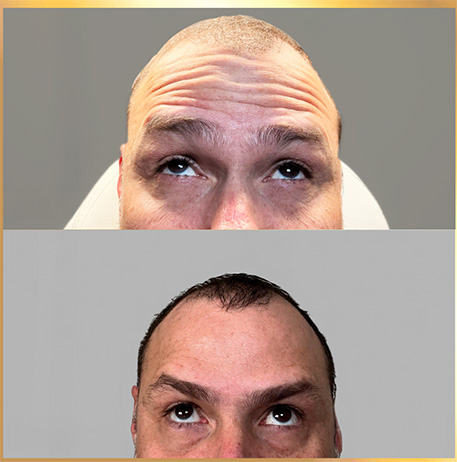 patient botox