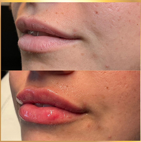 patient lip filler