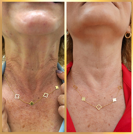 patient 7 neck lift with botox 