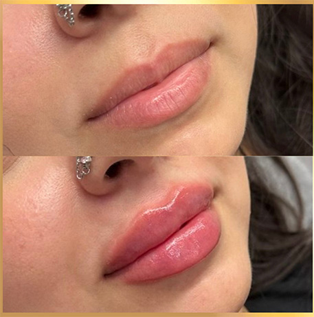 patient 12 russian lip fillers