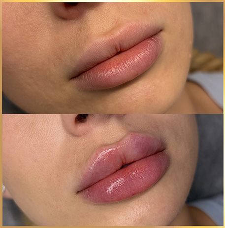 patient 15 russian lip fillers