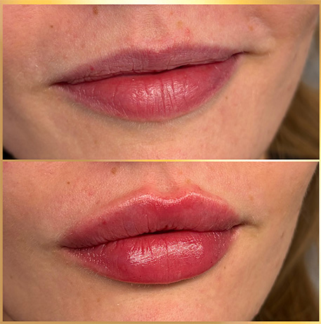 patient 16 russian lip fillers