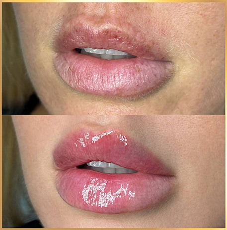patient 6 russian lip fillers