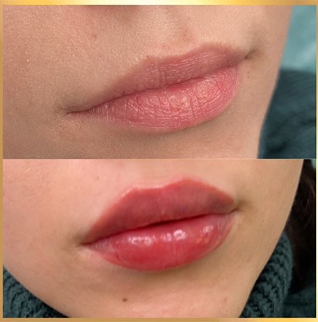 patient 9 russian lip fillers